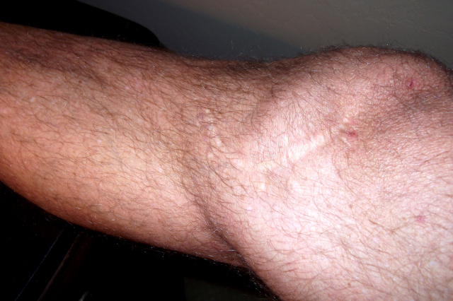 Cliff Smith's Knee Injury